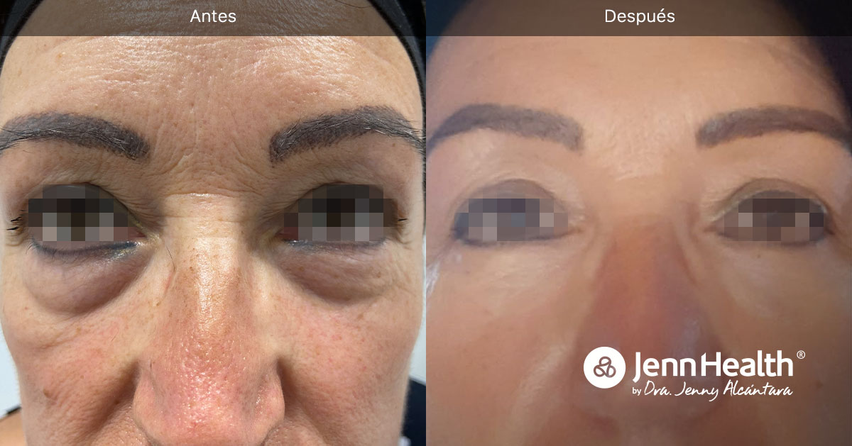 tratamiento para eliminar ojeras del rostro