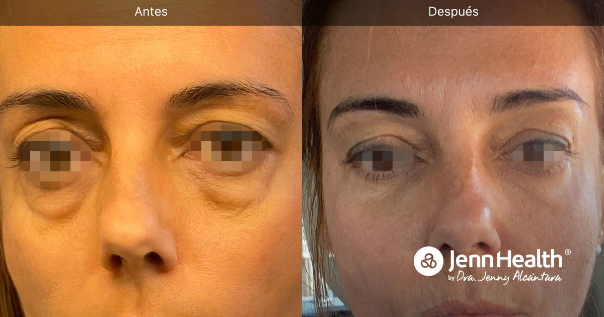 ¿Cómo eliminar las ojeras y las bolsas en los ojos de forma natural?
